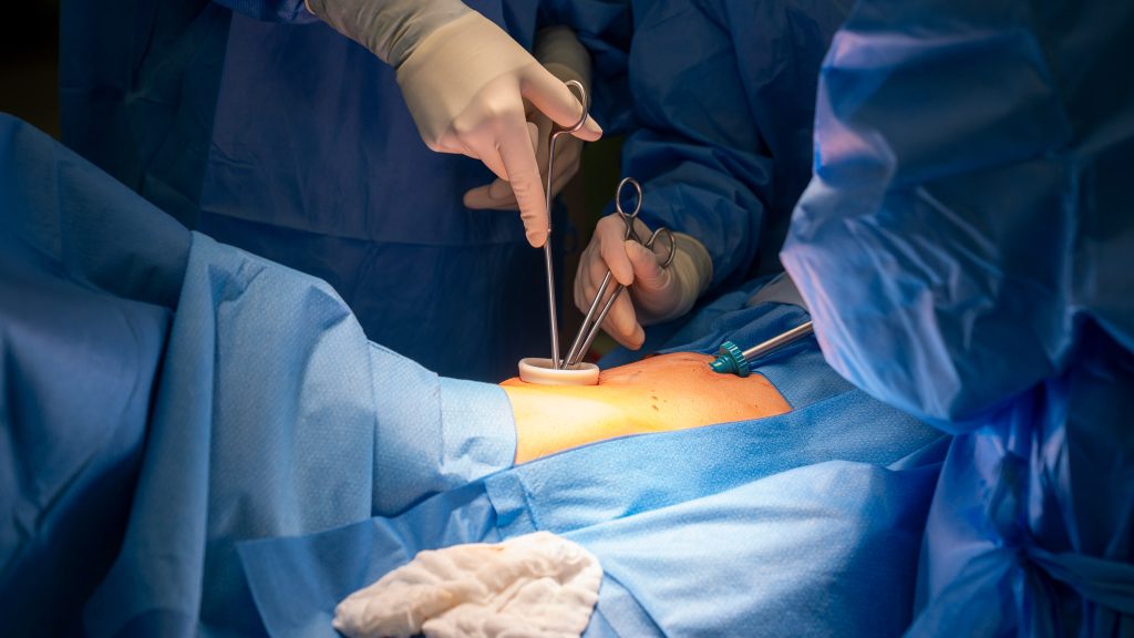 Operacja guza płuca w USK