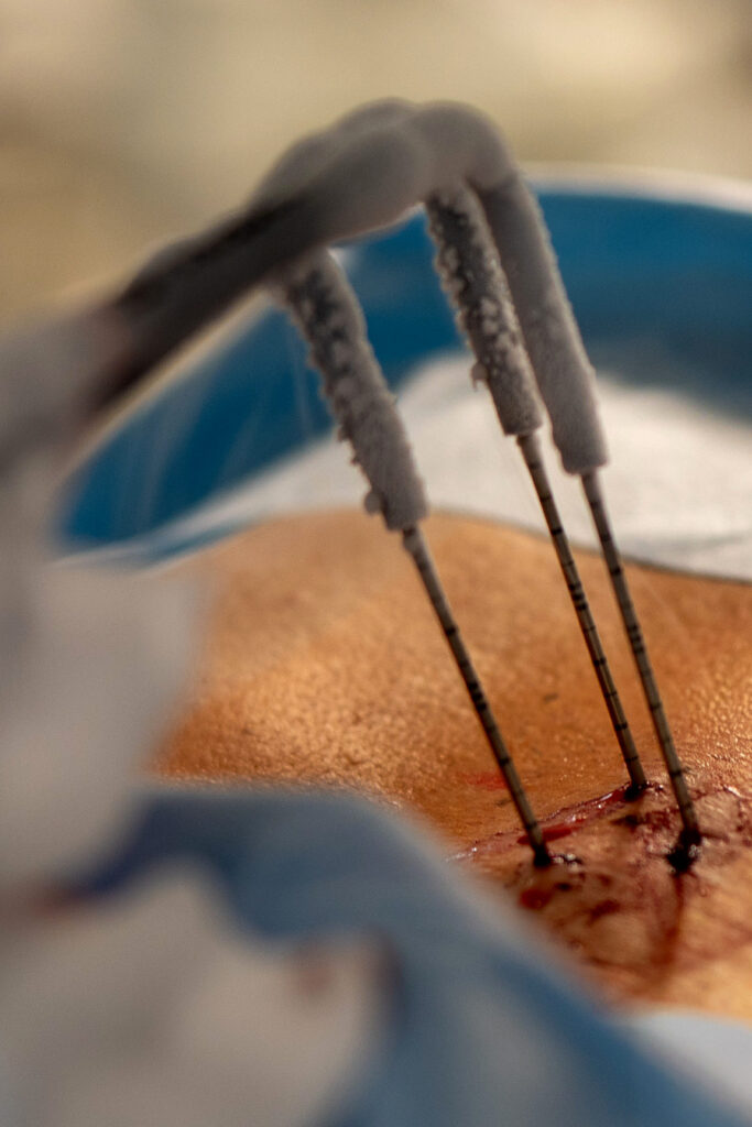 Operacja guza nerki w USK